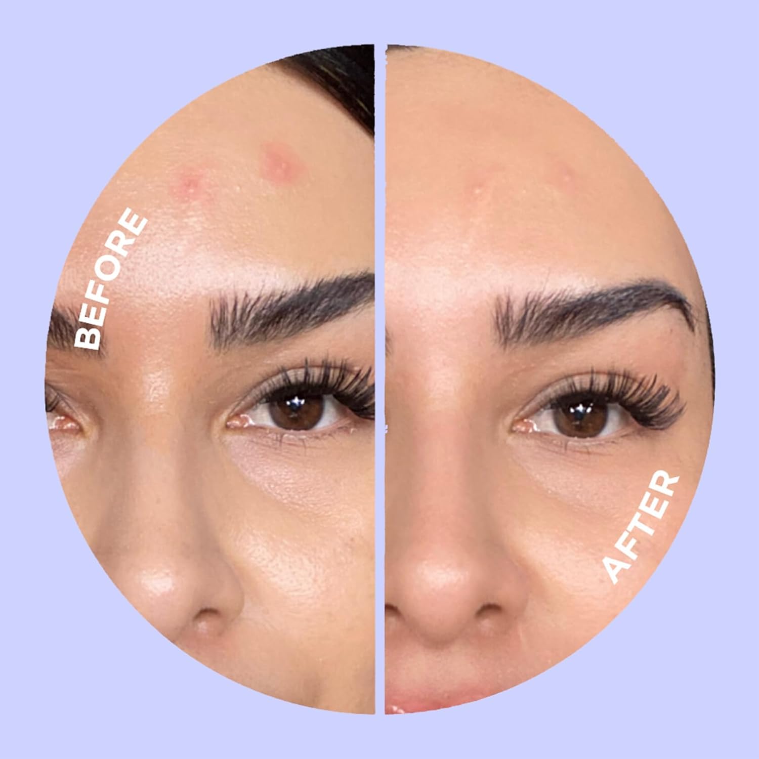 ZitSticka Pimple Patches for Face and Body, Hydrocolloid Patches to Cover Zits & Blemishes, Acne Patches or Zit Spot Stickers, Body Blemish Patch (UNDERCOVER INVISIBLE 36 Pack)